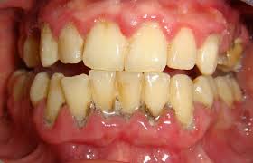 Resultado de imagen de enfermedad periodontal.