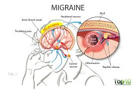 Image result for migraine