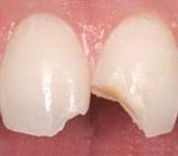 Image result for picture of a chipped front tooth