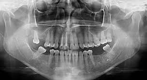 Resultado de imagen de radiografia panoramica dental