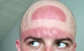 Image result for sunburn michigan fan