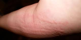 Image result for hives