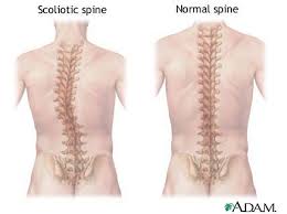 Image result for scoliosis