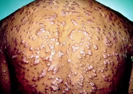 Image result for syphilis virus