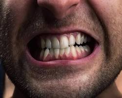 صورة طحن الأسنان