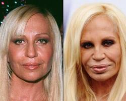 Imagen de Donatella Versace before and after plastic surgery