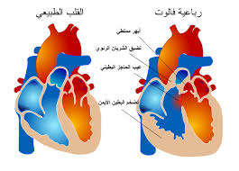 أمراض القلب الخلقية ومتلازمة داون Images?q=tbn:ANd9GcToAGQLxwnUfReBJimSi41jR_wvFcymj-unQs8DYfWBCLTkxIHX
