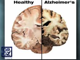 Bagaimana Cara Mengobati Penyakit Alzheimer Secara Alami