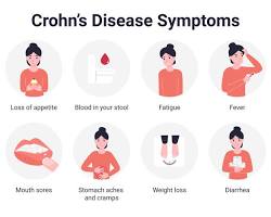 Fever symptom of Crohn's disease