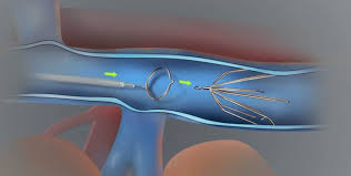 Ultrasonic Thrombectomy Device Market Growing Massively by AngioDynamics, 
Medtronic, BD