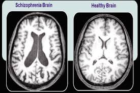 schizophrenia, brain function 