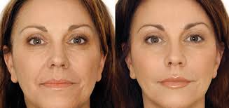 Image result for facial rejuvenation acupuncture before and after