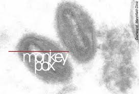 Image result for Monkeypox disease: What to know